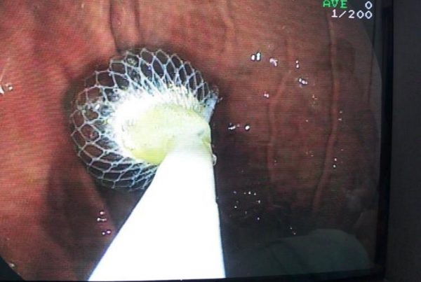 IMG_0192-27-12-18-04-45 проглоченный магнитный шарик