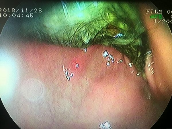 IMG_7286-18-12-18-04-46 трихобезоар желудка