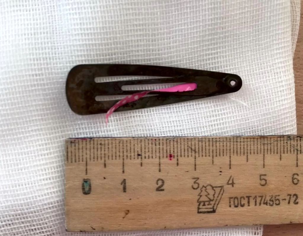 zakolka Девочка 3 года, проглотила заколку, которая находилась у неё в причёске