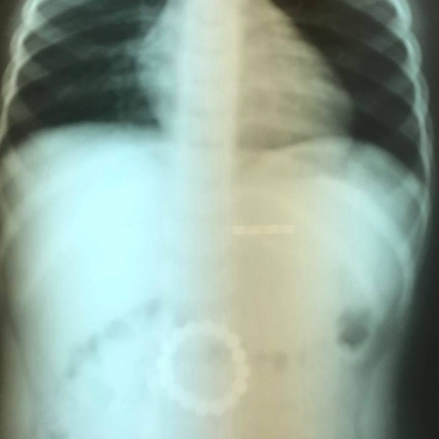 Мальчик 2 года играл с магнитным конструктором, в комплекте было 40 магнитных шариков. После, родители не досчитались 16 штук. Предположили, что ребёнок случайно их проглотил