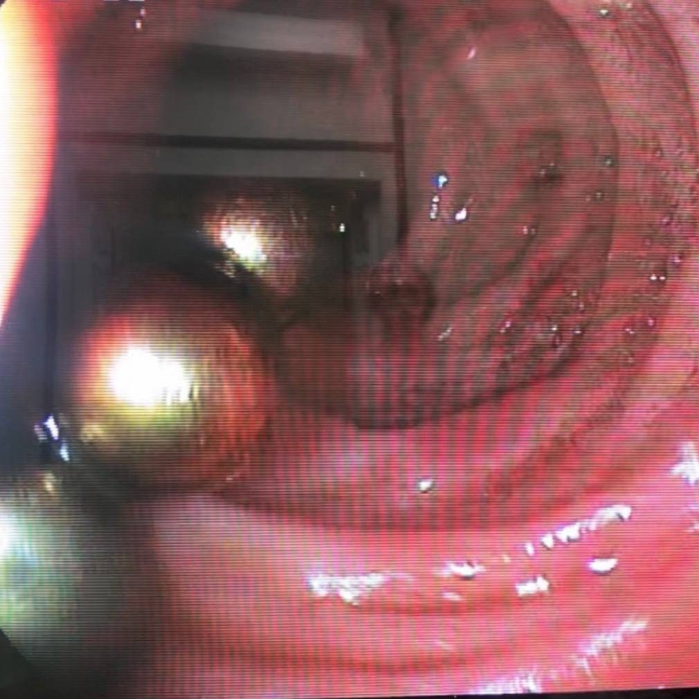 Мальчик 2 года играл с магнитным конструктором, в комплекте было 40 магнитных шариков. После, родители не досчитались 16 штук. Предположили, что ребёнок случайно их проглотил