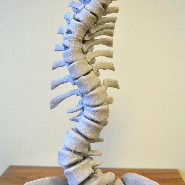 Хирурги ДГКБ им. З.А. Башляевой помогли пациентке с тяжелым искривлением позвоночника