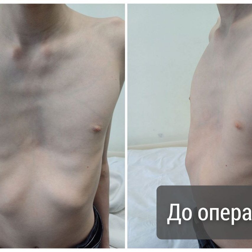 Теперь доступны операции по устранению врождённых деформаций грудной клетки