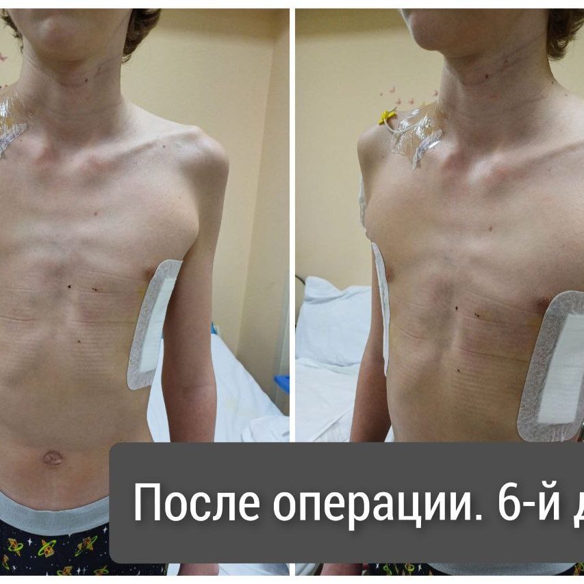 Теперь доступны операции по устранению врождённых деформаций грудной клетки