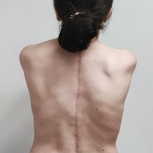 Хирурги ДГКБ им. З.А. Башляевой помогли пациентке с тяжелым искривлением позвоночника