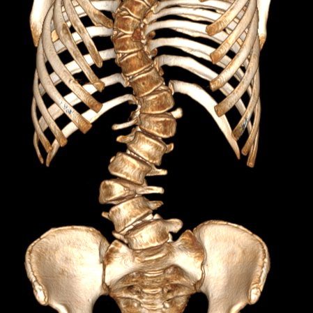 Хирурги ДГКБ им. З.А. Башляевой помогли пациентке с тяжелым искривлением позвоночника