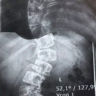 Хирурги ДГКБ им. З.А. Башляевой помогли пациентке с тяжелым искривлением позвоночника