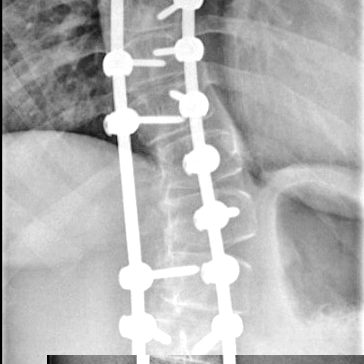 Хирурги ДГКБ им. З.А. Башляевой помогли пациентке с тяжелым искривлением позвоночника