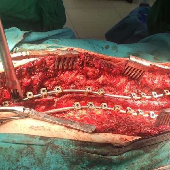 Хирурги ДГКБ им. З.А. Башляевой помогли пациентке с тяжелым искривлением позвоночника