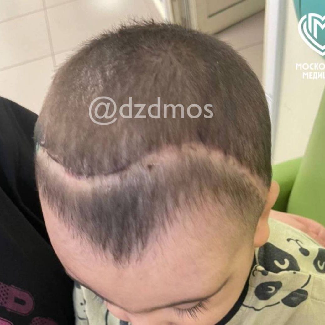 Московские нейрохирурги спасли мальчика с деформацией черепа